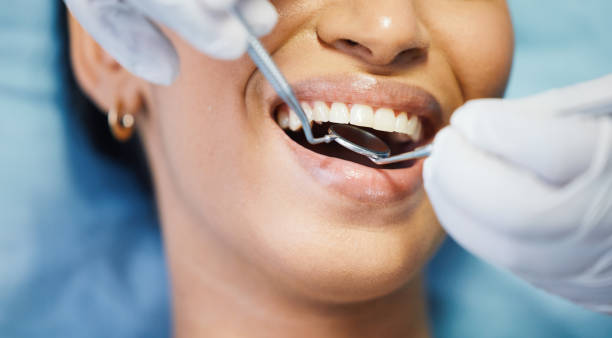 Best Emergency Wisdom Teeth Removal in Ashville, OH